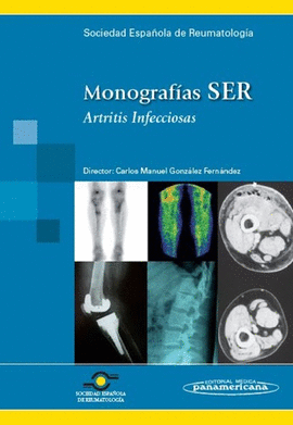 ARTRITIS INFECCIOSAS
