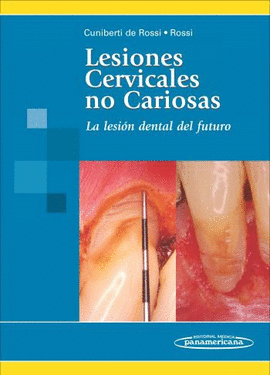LESIONES CERVICALES NO CARIOSA